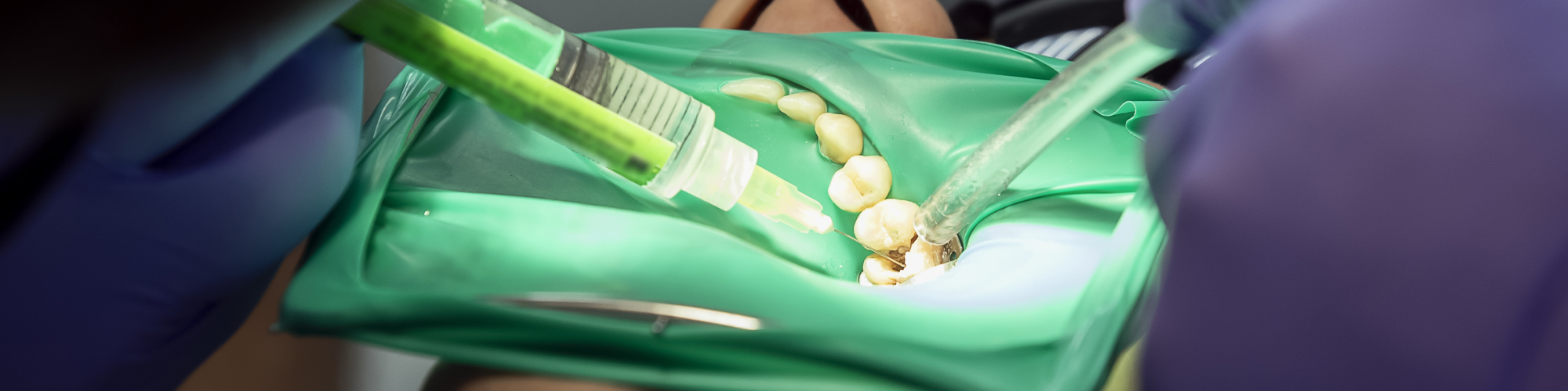 Root Canal